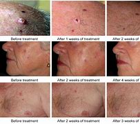 Image result for Actinic Solar Keratosis