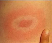 Image result for Diagnosing Lyme Disease