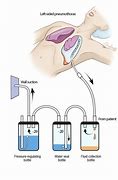 Image result for Chest Tube Connection