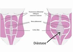 Image result for Diastase Abdominal