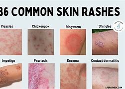 Image result for Allergy Rash On Back