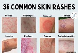 Image result for Common Skin Rashes Itchy