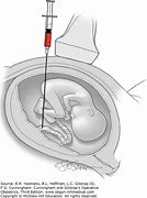 Image result for Prenatal Surgery Diagram