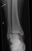 Image result for Maisonneuve Fracture Ankle