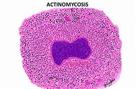 Image result for actknomicosis