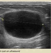 Image result for 7Mm Cyst