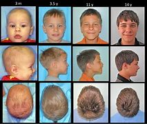 Image result for Metopic Craniosynostosis Surgery