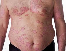 Image result for Psoriasis Papules
