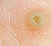 Image result for Viral Skin Infections Molluscum Contagiosum
