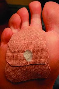 Image result for Foot Warts Treatment