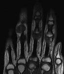 Image result for Giant Cell Tumor Thumb