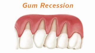 Image result for Minor Gum Recession