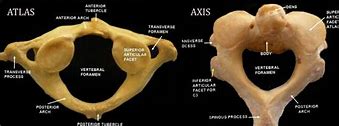 Image result for Cervical Vertebrae Atlas Axis