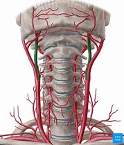 Image result for Carotid and Aorta