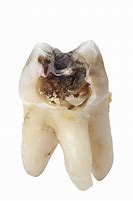 Image result for Decayed Teeth