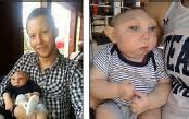 Image result for Oldest Living Baby with Anencephaly