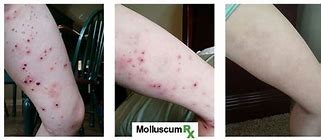 Image result for Molluscum Treatment Before and After