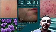 Folliculitis Symptoms, causes and treatment