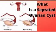 What is a Septated Ovarian Cyst