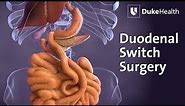 Duodenal Switch Surgery | Duke Health
