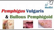 Vesiculobullous Skin Diseases | Pemphigus Vulgaris vs. Bullous Pemphigoid