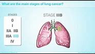 Staging of Lung Cancer