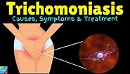 Trichomoniasis: Causes, Symptoms, Diagnosis, Treatments and prevention