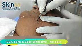 Warts Removal on face | Warts Treatment on face -Skinaa Clinic India