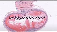Verrucous cyst (benign cyst with HPV infection) pathology dermpath dermatology dermatopathology