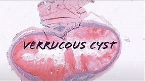 Verrucous cyst (benign cyst with HPV infection) pathology dermpath dermatology dermatopathology