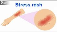 What is a stress rash? - Dr. Rajdeep Mysore