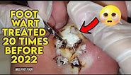 BIGGEST FOOT WART EVER??? [TREATED 20 TIMES BEFORE ] BY MISS FOOT FIXER