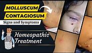 Molluscum contagiosum | Signs and Symptoms | Causes | Homeopathic Treatment of Molluscum Contagiosum
