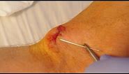 How To Give Yourself Stitches (Sutures)