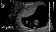 Scan of the Week: 9 week old baby