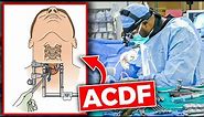Anterior Cervical Discectomy and Fusion (ACDF)