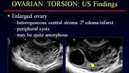 Sonographic Evaluation of Ovarian Torsion