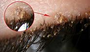Pubic lice Symptoms – Causes Treatment Signs and Symptoms of Pubic lice and Pubic Crab