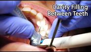 Dentist Filling A Cavity Between Teeth