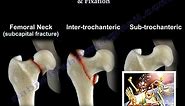 Hip Fracture Types & Fixation - Everything You Need To Know - Dr. Nabil Ebraheim