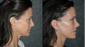 Mini Face Lift and Eye Lift on 43 Year Old Woman y Dr Andrew Jacono #minifacelift