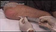 Olecranon Bursitis - Aspiration and Injection - In Vivo Series