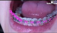 Braces checkups - Power chains - 16 months with braces - Tooth Time Family Dentistry