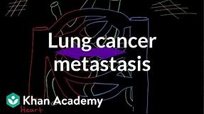 Lung cancer metastasis | Respiratory system diseases | NCLEX-RN | Khan Academy