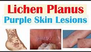 Lichen Planus (“Purple Skin Lesions”) | Causes, Signs & Symptoms, Diagnosis, Treatment
