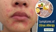 Citrus Allergy: Symptoms, Foods to Avoid, and More