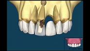 Bridge V/s Dental Implant
