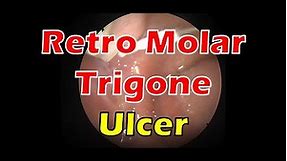 Retromolar trigone ulcerataion treatment