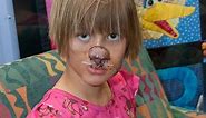 Raccoon Eats Baby's Face; Now 11, She Gets New Ear