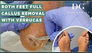 Callus removal from feet: both feet and three verruca (plantar warts) treatment